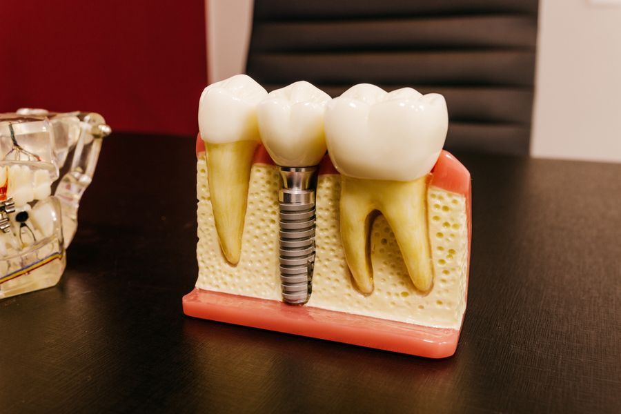 Full Mouth Implants