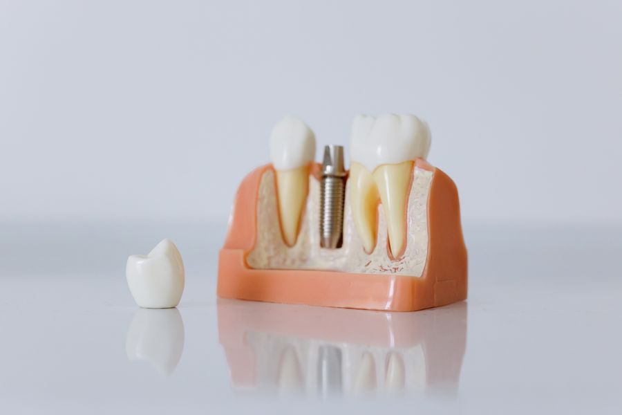 Zygomatic Implants